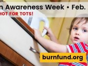 Burn Awareness Week to highlight top burn hazards for young children